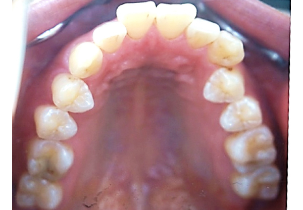 口腔内 治療前
