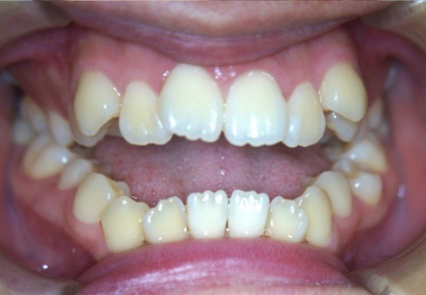口腔内 治療前